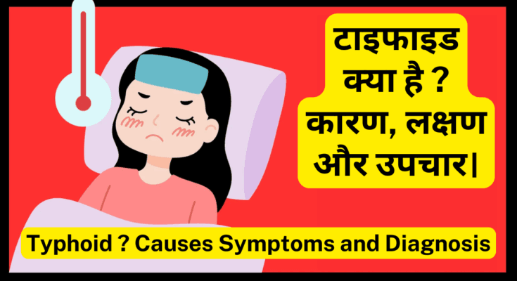 टाइफाइड-Typhoid क्या है कारण, लक्षण और उपचार। Typhoid Causes Symptoms and Best Diagnosis