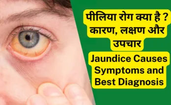 पीलिया-Jaundice रोग क्या है कारण, लक्षण और उपचार। Jaundice Causes Symptoms and Best Diagnosis