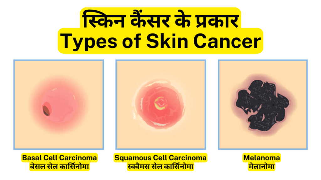 स्किन कैंसर-Skin Cancer : कारण, लक्षण और उपचार | Skin Cancer : Causes, Symptoms and Best Treatment