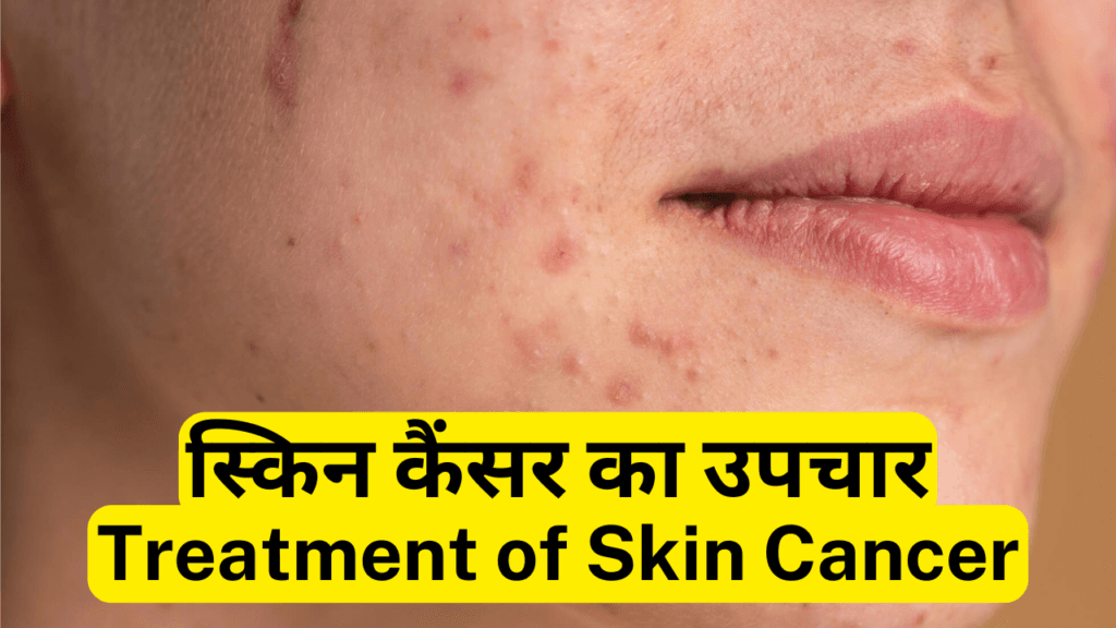 स्किन कैंसर-Skin Cancer : कारण, लक्षण और उपचार | Skin Cancer : Causes, Symptoms and Best Treatment