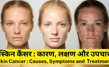 स्किन कैंसर-Skin Cancer कारण, लक्षण और उपचार Skin Cancer Causes, Symptoms and Best Treatment