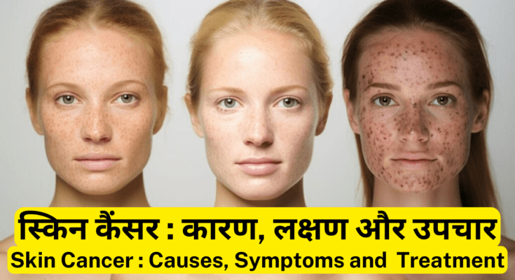 स्किन कैंसर-Skin Cancer कारण, लक्षण और उपचार Skin Cancer Causes, Symptoms and Best Treatment