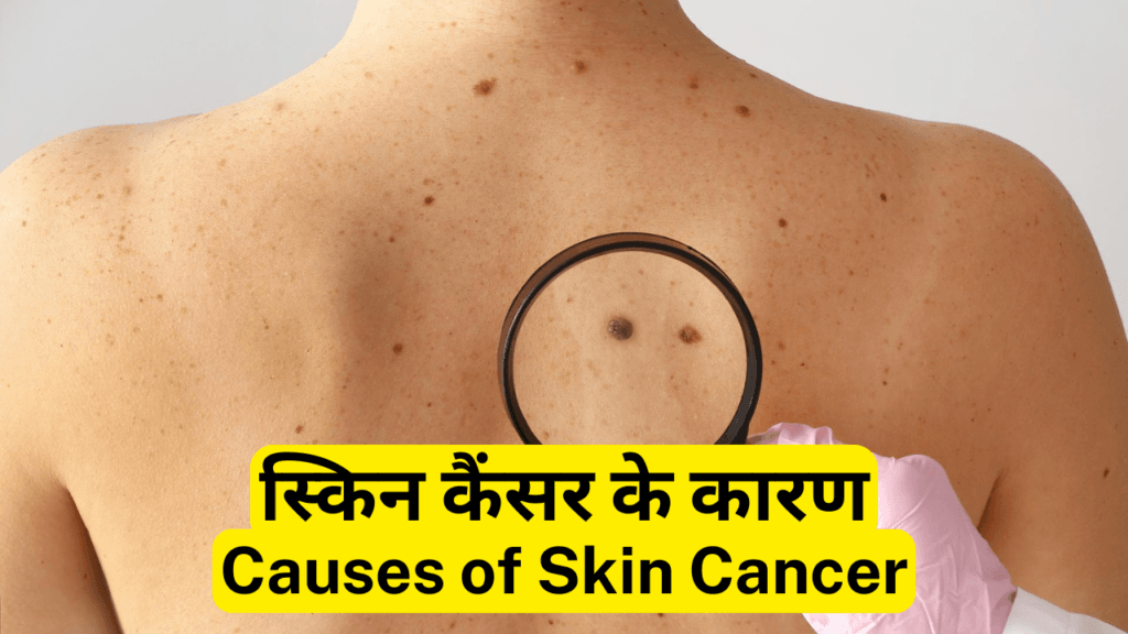 स्किन कैंसर-Skin Cancer : कारण, लक्षण और उपचार | Skin Cancer : Causes, Symptoms and Best Treatment